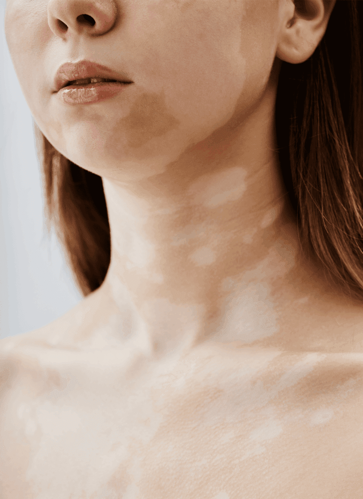 Usuwanie przebarwień Inowrocław